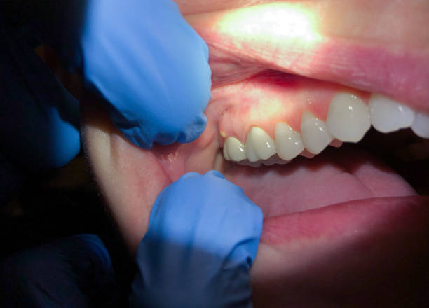 Best Broken or Chipped Tooth Repair in Town N Country, FL